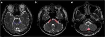 Small Posterior Cranial Fossa and Cerebellopontine Cistern Volumes Are Associated With Bilateral Trigeminal Neuralgia